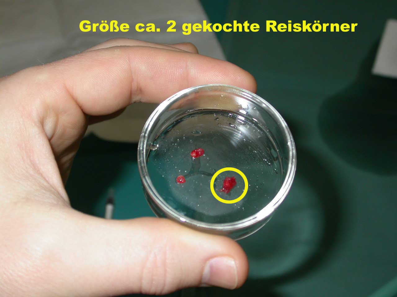 erwachsene biopsie krankheit mitochondriale beginn ergebnis